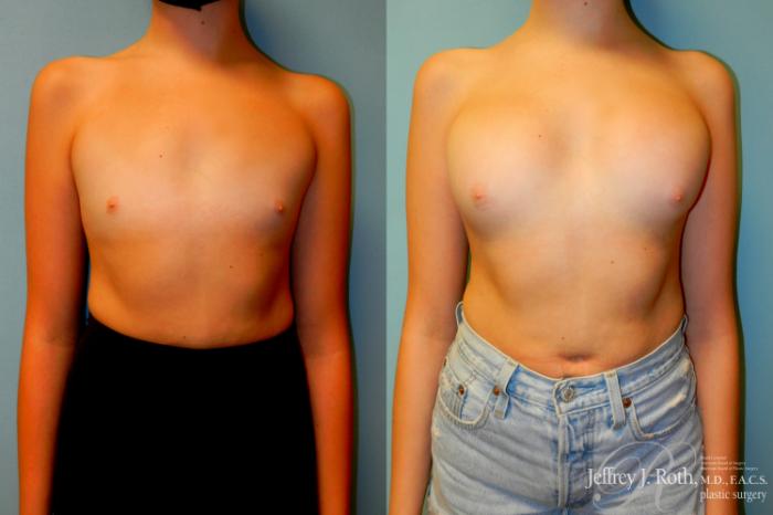 Before & After Breast Augmentation Case 183 Front View in Las Vegas and Henderson, NV