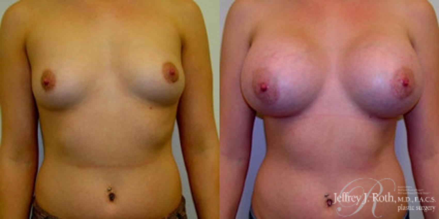 Before & After Breast Augmentation Case 219 Front View in Las Vegas and Henderson, NV