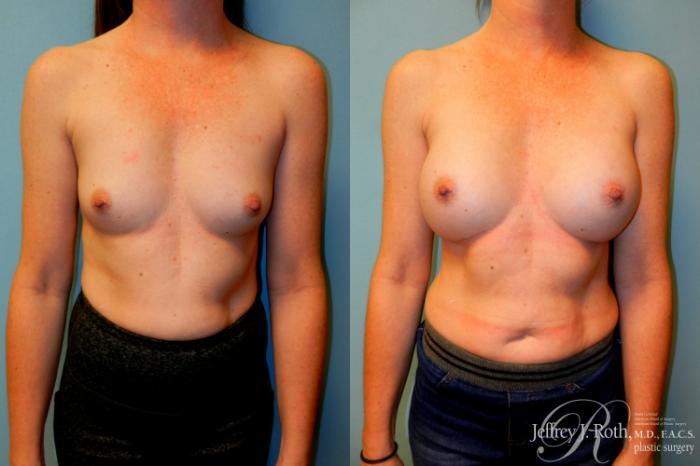 Before & After Breast Augmentation Case 247 Front View in Las Vegas and Henderson, NV