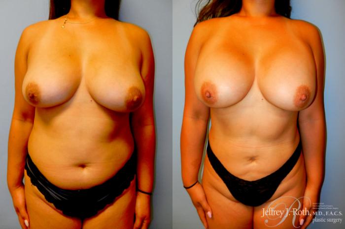 Before & After Breast Augmentation Case 306 Front View in Las Vegas and Henderson, NV