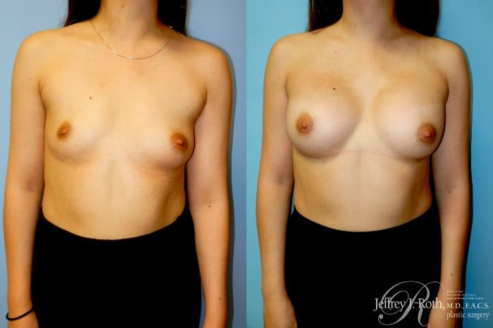 Before & After Breast Augmentation Case 324 Front View in Las Vegas and Henderson, NV