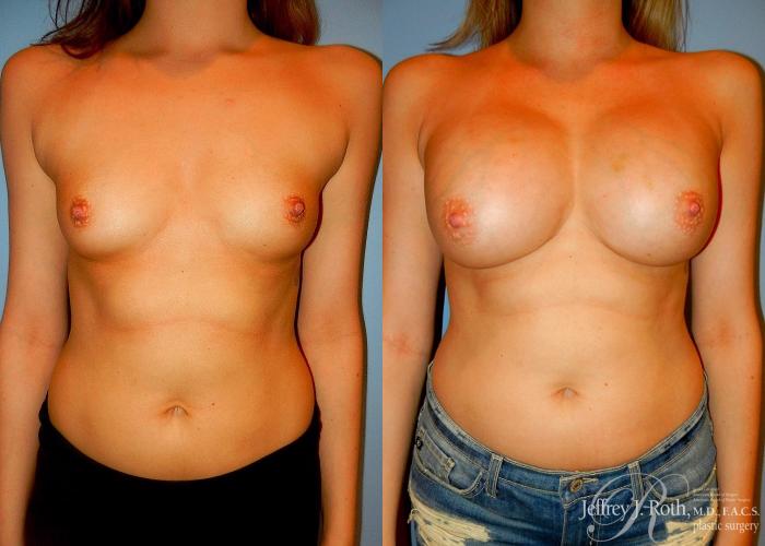 Before & After Breast Augmentation Case 36 View #1 View in Las Vegas and Henderson, NV
