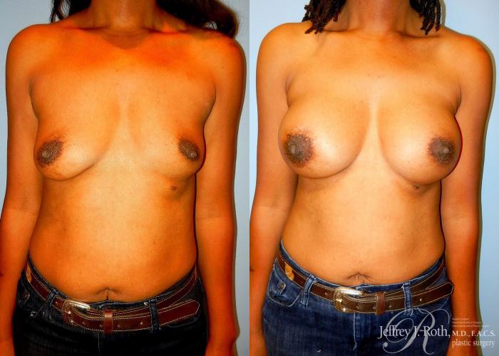 Before & After Breast Augmentation Case 39 View #1 View in Las Vegas and Henderson, NV