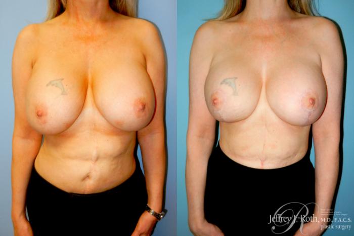 Before & After Breast Augmentation Revision Case 308 Front View in Las Vegas and Henderson, NV