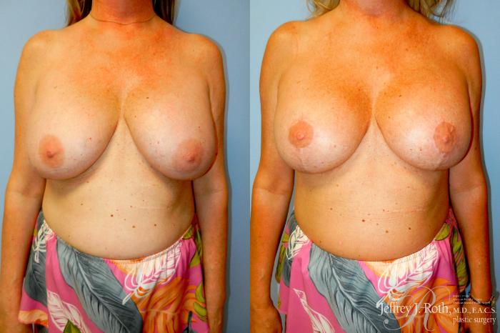 Before & After Breast Augmentation Revision Case 322 Front View in Las Vegas and Henderson, NV