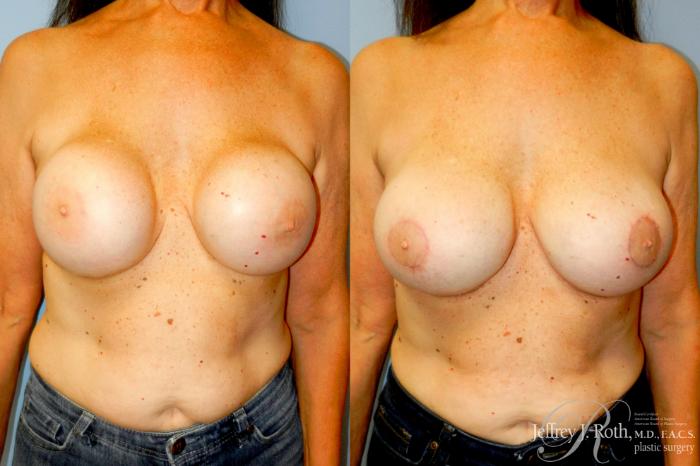 Before & After Breast Augmentation Revision Case 344 Front View in Las Vegas and Henderson, NV