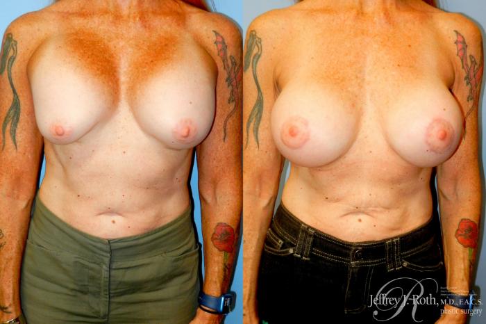 Before & After Breast Augmentation Revision Case 349 Front View in Las Vegas and Henderson, NV