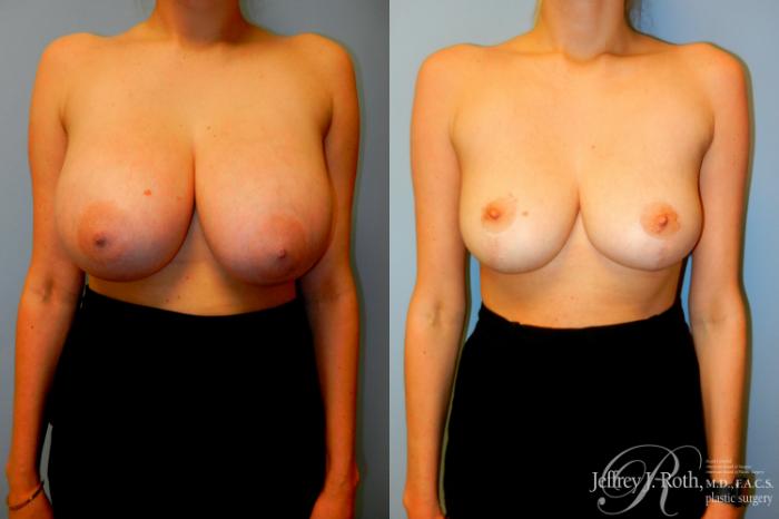 Before & After Breast Lift Case 231 Front View in Las Vegas and Henderson, NV
