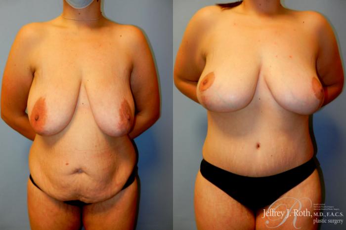 Before & After Breast Lift Case 234 Front View in Las Vegas and Henderson, NV