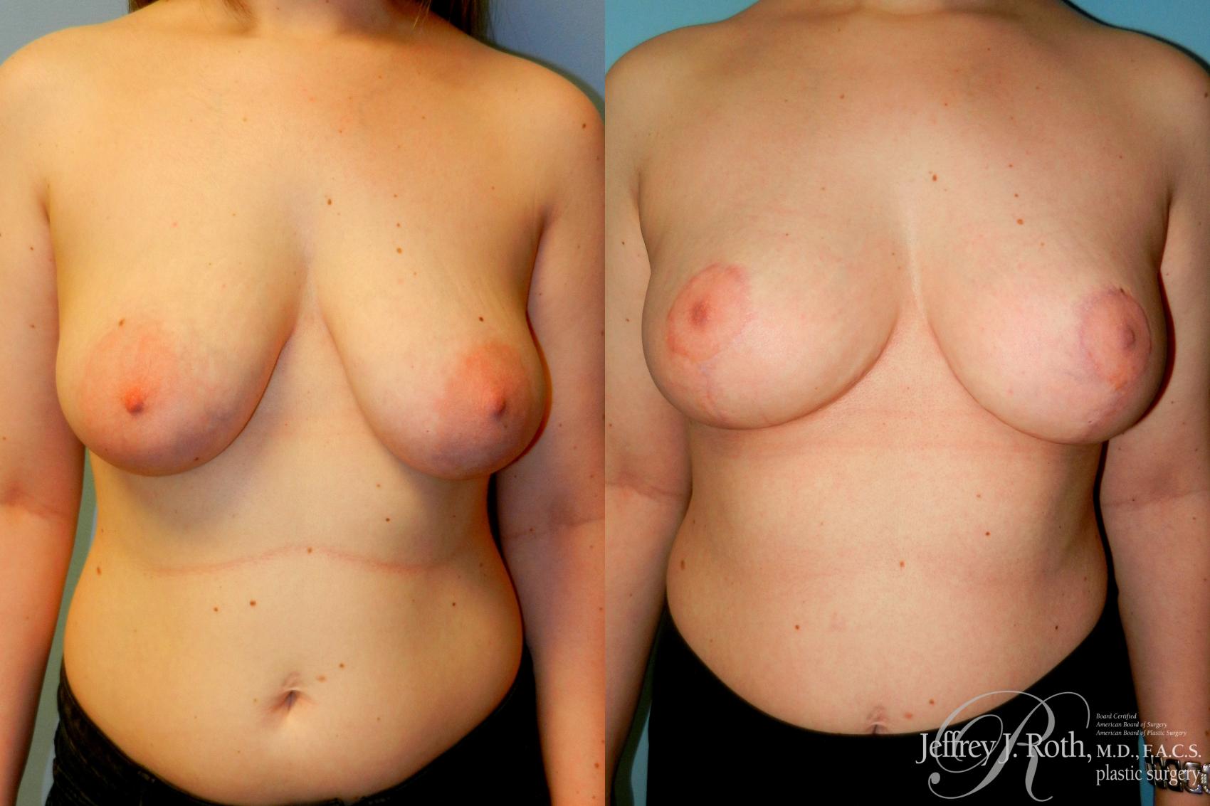 Before & After Breast Lift Case 265 Front View in Las Vegas and Henderson, NV
