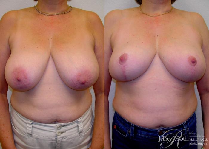 Before & After Breast Lift Case 59 View #1 View in Las Vegas and Henderson, NV