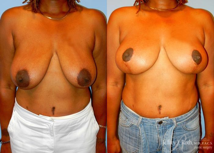 Before & After Breast Lift Case 60 View #1 View in Las Vegas and Henderson, NV