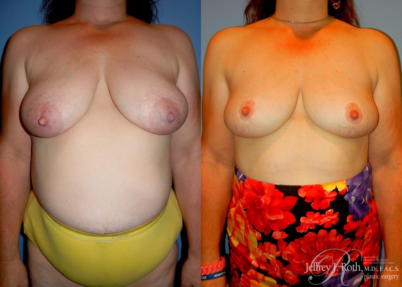 Before & After Breast Lift Case 61 View #1 View in Las Vegas and Henderson, NV
