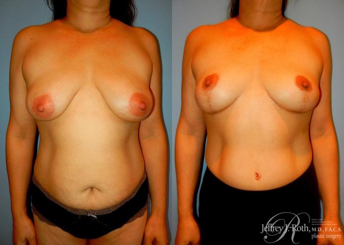 Before & After Breast Lift Case 62 View #1 View in Las Vegas and Henderson, NV