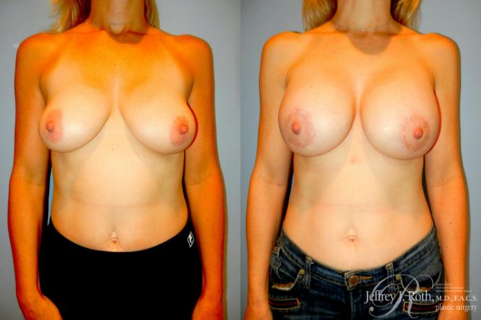 Before & After Breast Lift With Implants Case 295 Front View in Las Vegas and Henderson, NV