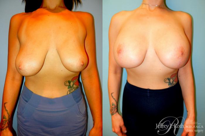 Before & After Breast Lift With Implants Case 303 Front View in Las Vegas and Henderson, NV