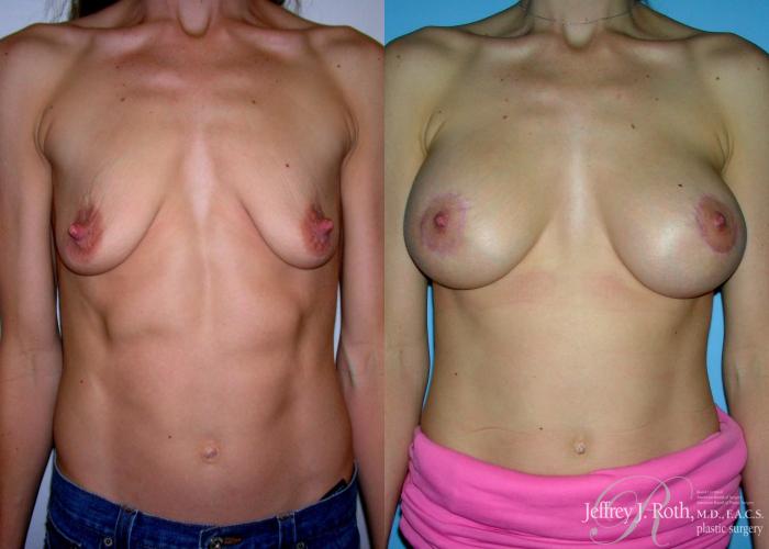 Before & After Breast Lift With Implants Case 65 View #1 View in Las Vegas and Henderson, NV
