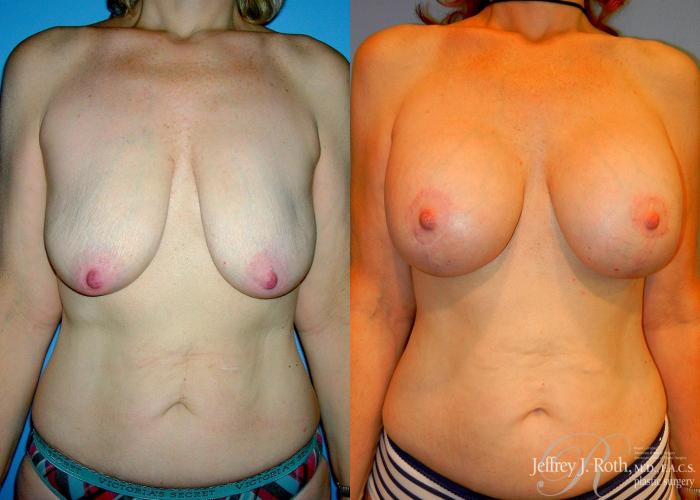 Before & After Breast Lift With Implants Case 66 View #1 View in Las Vegas and Henderson, NV