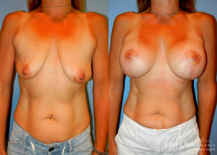Before & After Breast Lift With Implants Case 69 View #1 View in Las Vegas and Henderson, NV