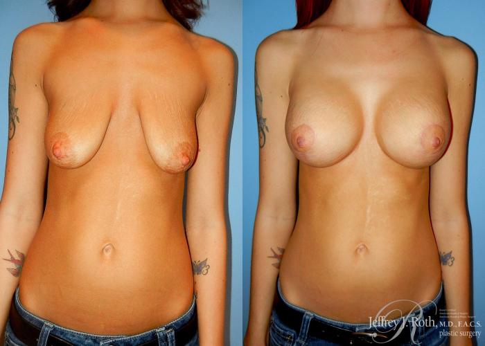 Before & After Breast Lift With Implants Case 70 View #1 View in Las Vegas, NV