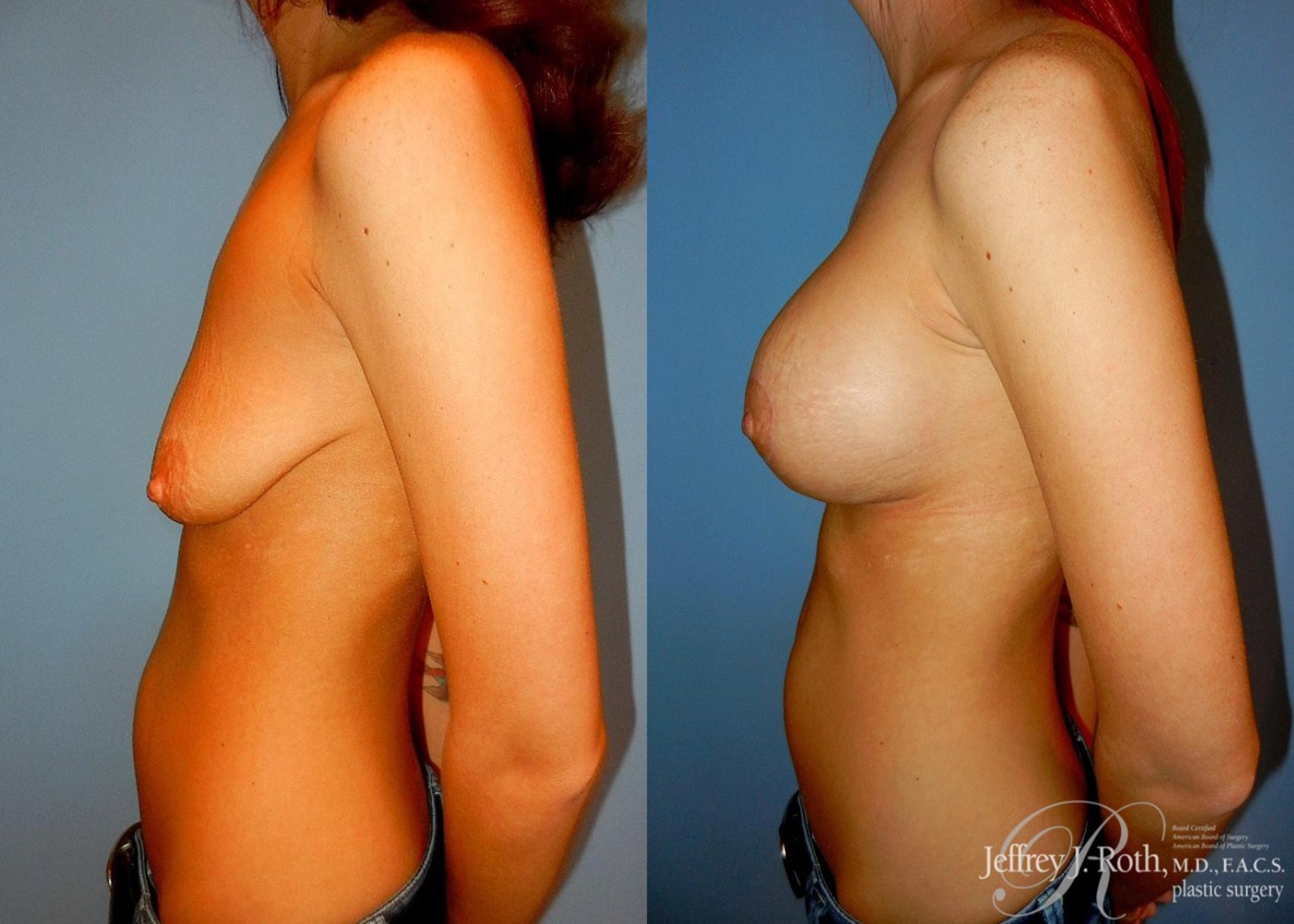 Before & After Breast Lift With Implants Case 70 View #3 View in Las Vegas and Henderson, NV