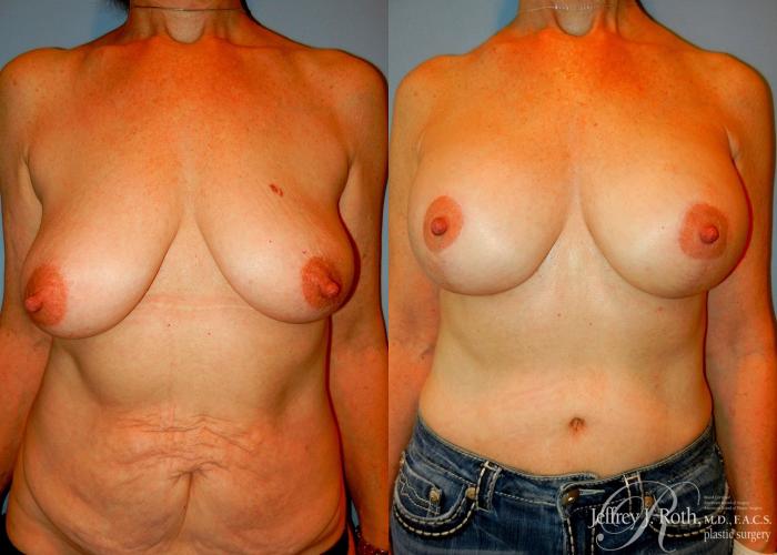 Before & After Breast Lift With Implants Case 74 View #1 View in Las Vegas and Henderson, NV