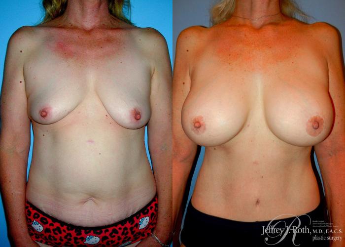 Before & After Breast Lift With Implants Case 77 View #1 View in Las Vegas and Henderson, NV
