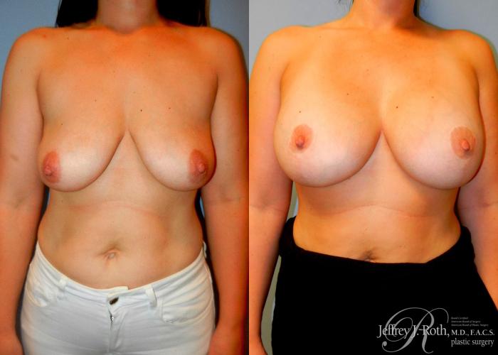 Before & After Breast Lift With Implants Case 78 View #1 View in Las Vegas and Henderson, NV