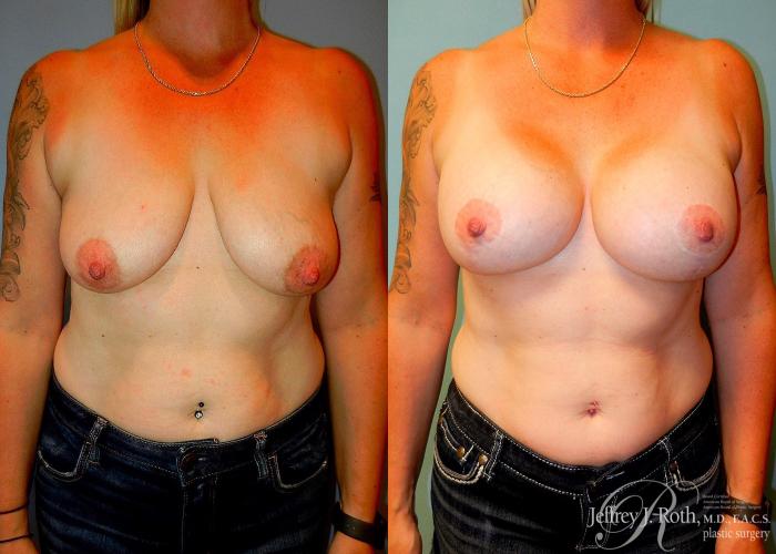 Before & After Breast Lift With Implants Case 80 View #1 View in Las Vegas, NV