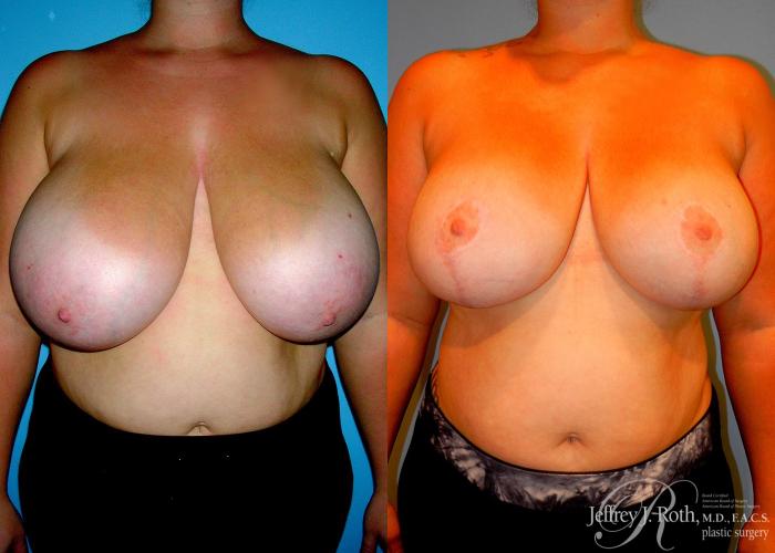 Before & After Breast Reduction Case 85 View #1 View in Las Vegas and Henderson, NV