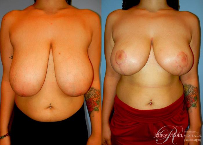 Before & After Breast Reduction Case 88 View #1 View in Las Vegas, NV