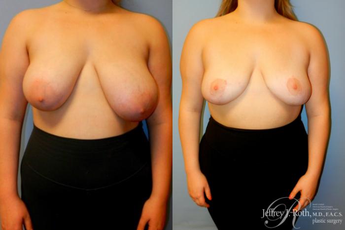 Before & After Breast Reduction Case 89 View #1 View in Las Vegas and Henderson, NV