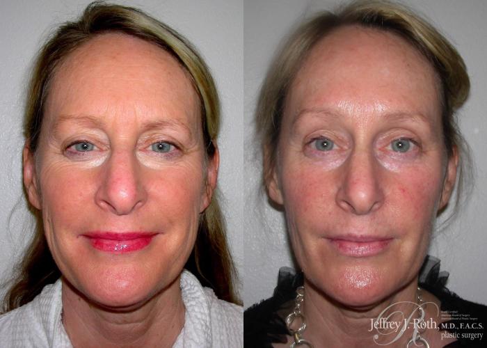 Before & After Brow Lift Case 158 View #1 View in Las Vegas and Henderson, NV