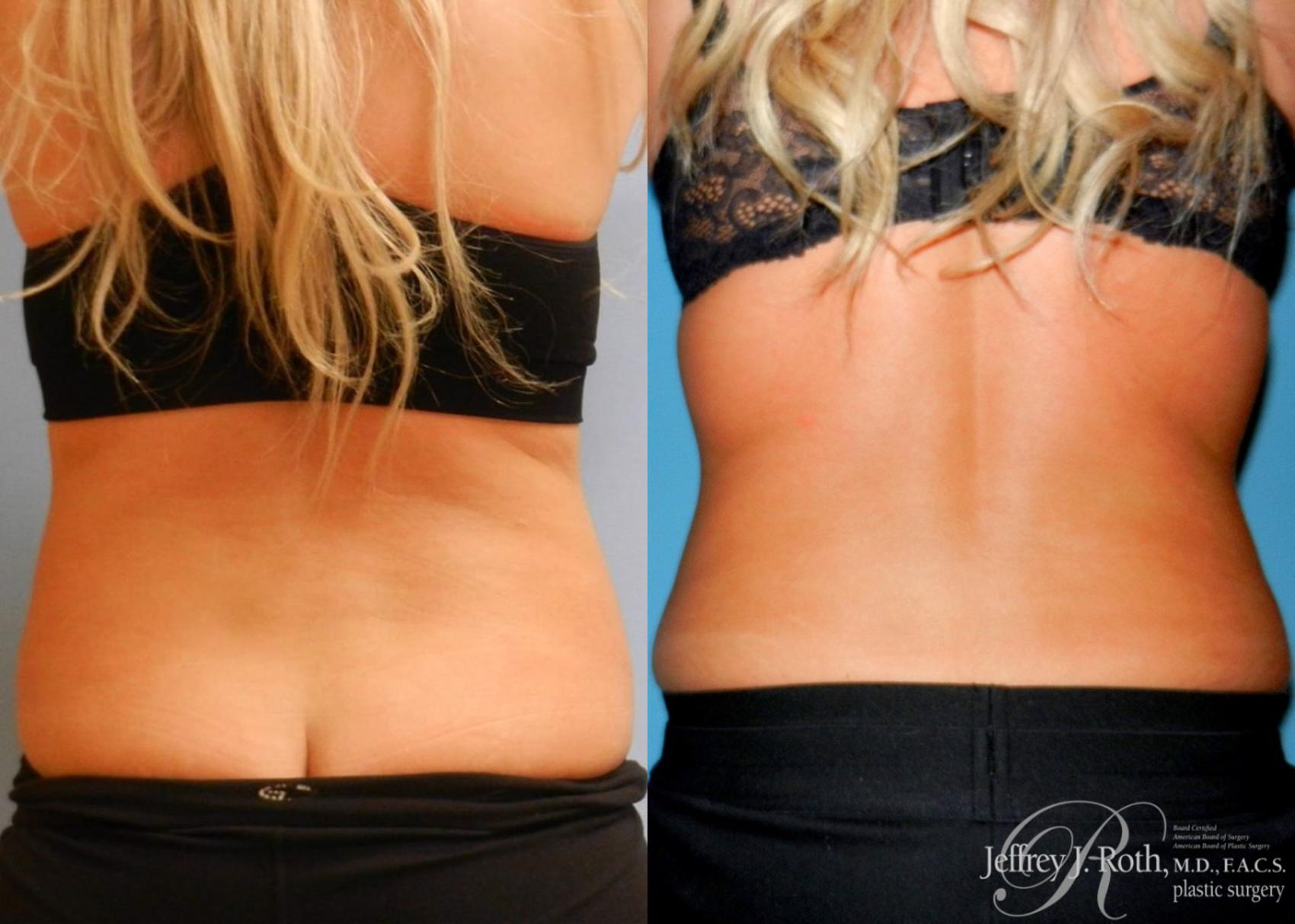 Before & After CoolSculpting® Case 3 View #1 View in Las Vegas and Henderson, NV