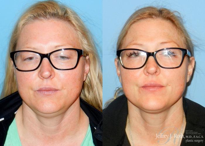 Before & After CoolSculpting® Case 4 View #1 View in Las Vegas and Henderson, NV