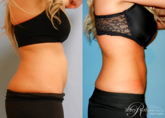 Before & After CoolSculpting® Case 5 View #1 View in Las Vegas and Henderson, NV