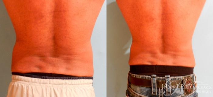 Before & After CoolSculpting® Case 165 View #1 View in Las Vegas and Henderson, NV