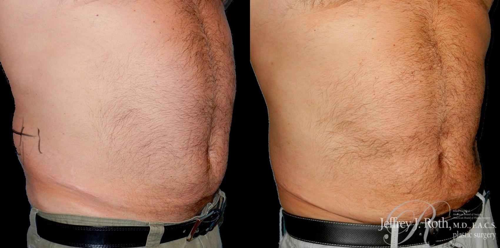 Before & After CoolSculpting® for Men Case 166 View #1 View in Las Vegas and Henderson, NV
