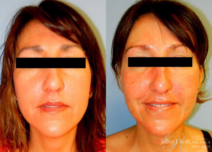 Before & After Dermal Fillers Case 146 View #1 View in Las Vegas and Henderson, NV