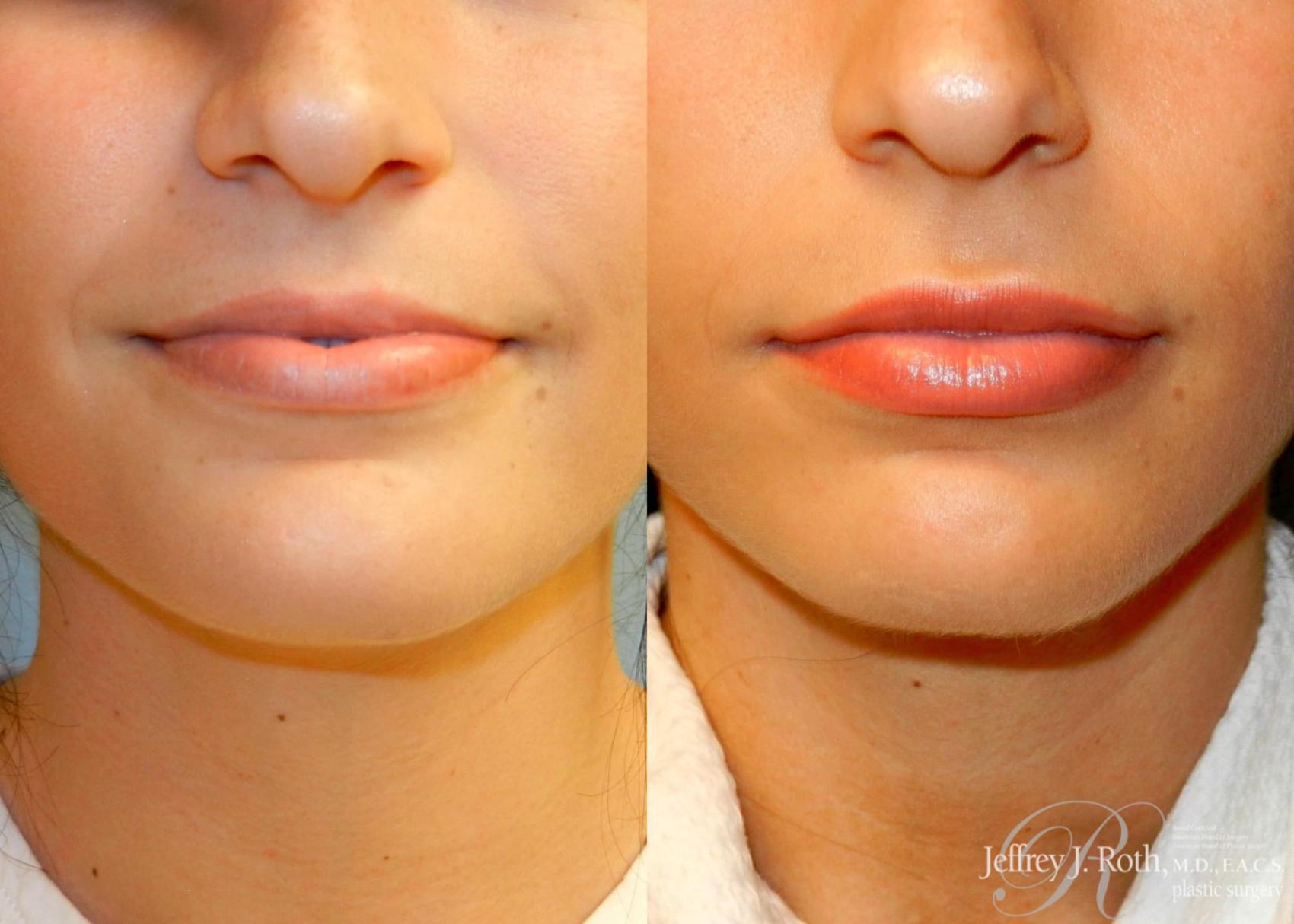 Before & After Dermal Fillers Case 147 View #1 View in Las Vegas and Henderson, NV