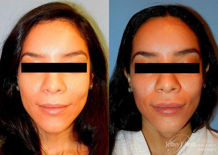 Before & After Dermal Fillers Case 155 View #1 View in Las Vegas and Henderson, NV