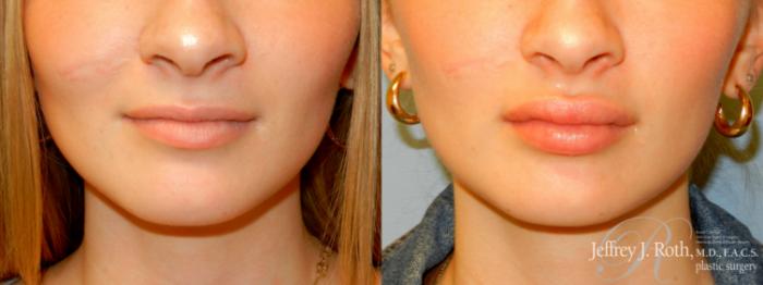 Before & After Dermal Fillers Case 244 Front View in Las Vegas and Henderson, NV