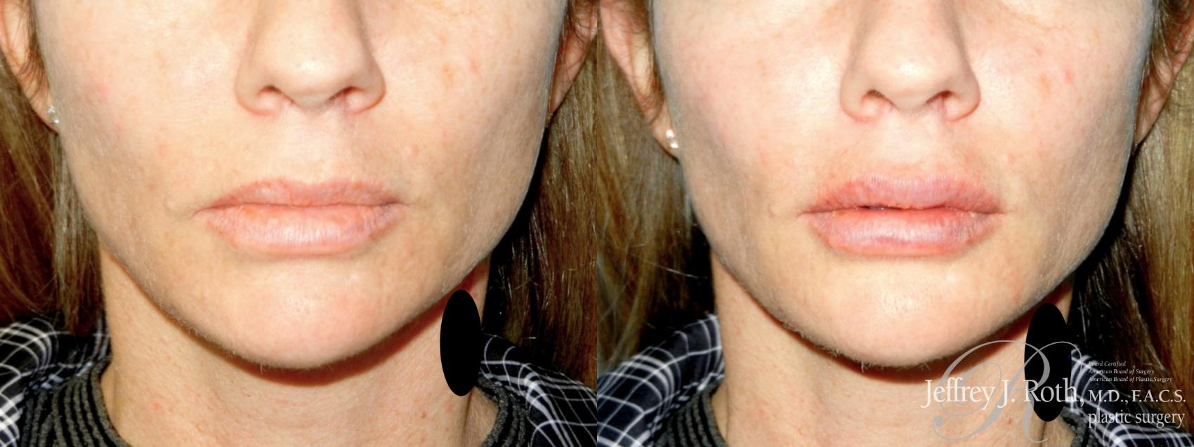 Before & After Dermal Fillers Case 346 Front View in Las Vegas and Henderson, NV