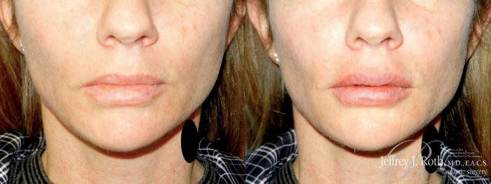 Before & After Dermal Fillers Case 346 Front View in Las Vegas and Henderson, NV