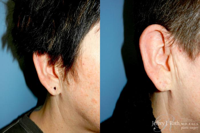 Before & After Earlobe Repair Surgery Case 345 Right Oblique View in Las Vegas and Henderson, NV