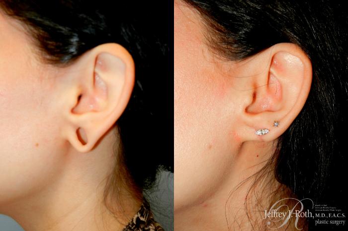 Before & After Earlobe Repair Surgery Case 350 Left Side View in Las Vegas and Henderson, NV