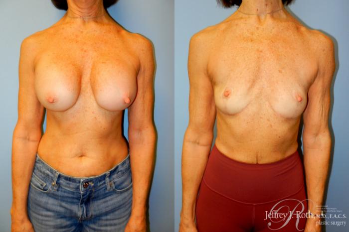 Before & After Breast Lift Case 253 Front View in Las Vegas and Henderson, NV