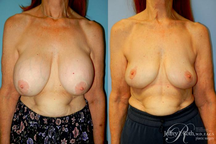 Before & After Explant Surgery Case 313 Front View in Las Vegas and Henderson, NV