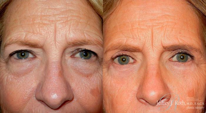 Before & After Eyelid Surgery Case 129 View #1 View in Las Vegas and Henderson, NV