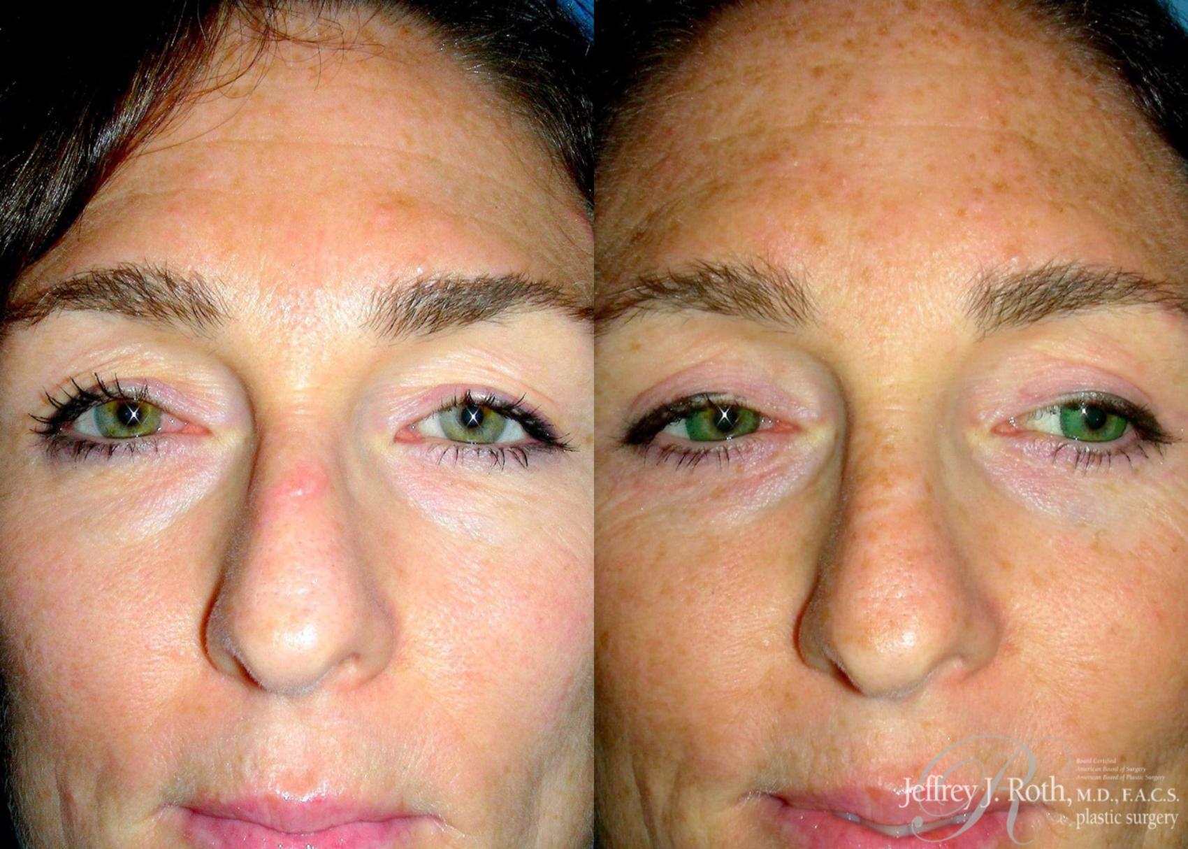 Before & After Eyelid Surgery Case 130 View #1 View in Las Vegas and Henderson, NV